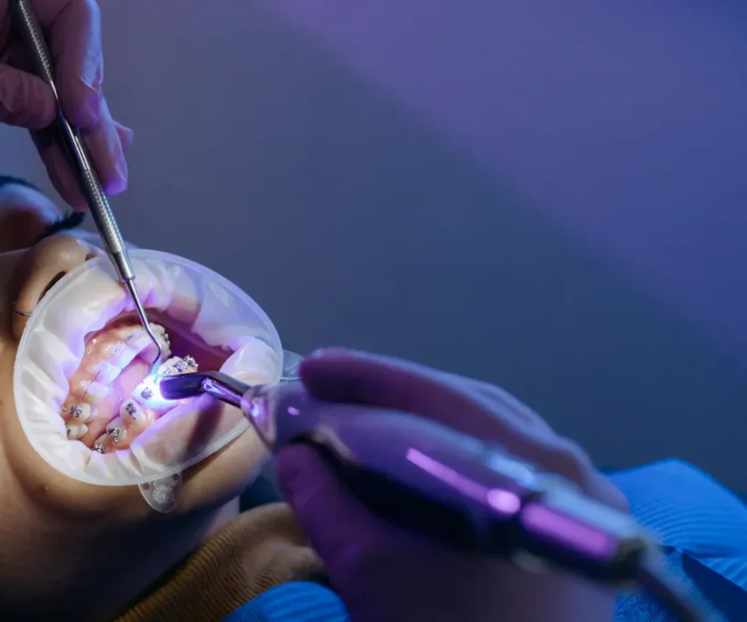 Why Consider TMO as an Alternative to TPO for UV Curing